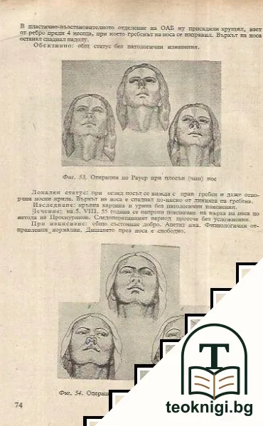 Пластично -възставителната хирургия при ринопластика — снимка 4
