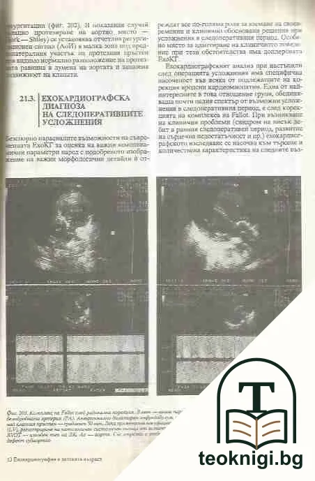 Ехокардиография в детската възраст — снимка 2